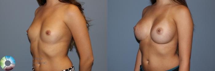 Before & After Breast Augmentation Case 11502 Left Oblique in Denver and Colorado Springs, CO