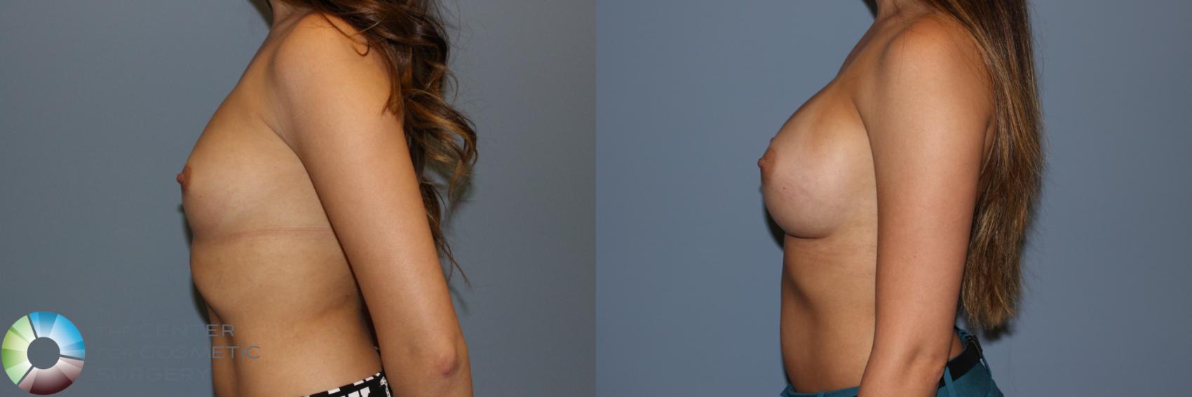 Before & After Breast Augmentation Case 11502 Left Side View in Denver & Golden, CO