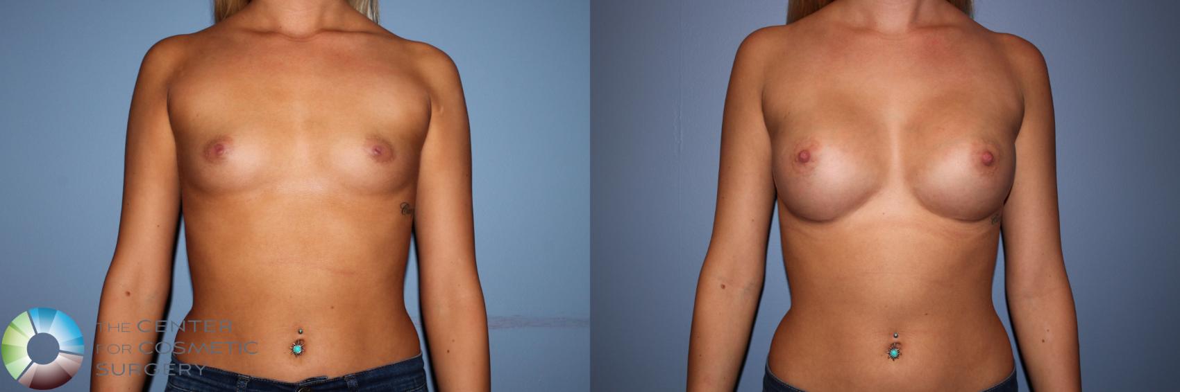 Before & After Breast Augmentation Case 11503 Front in Denver, CO