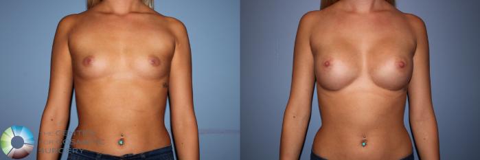 Before & After Breast Augmentation Case 11503 Front in Denver, CO