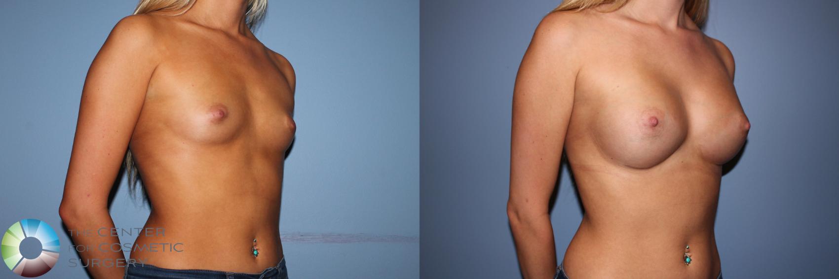 Before & After Breast Augmentation Case 11503 Right Oblique View in Denver & Golden, CO