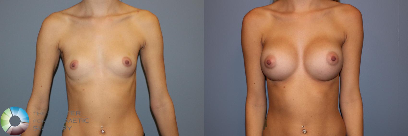 Before & After Breast Augmentation Case 11528 Front View in Golden, CO