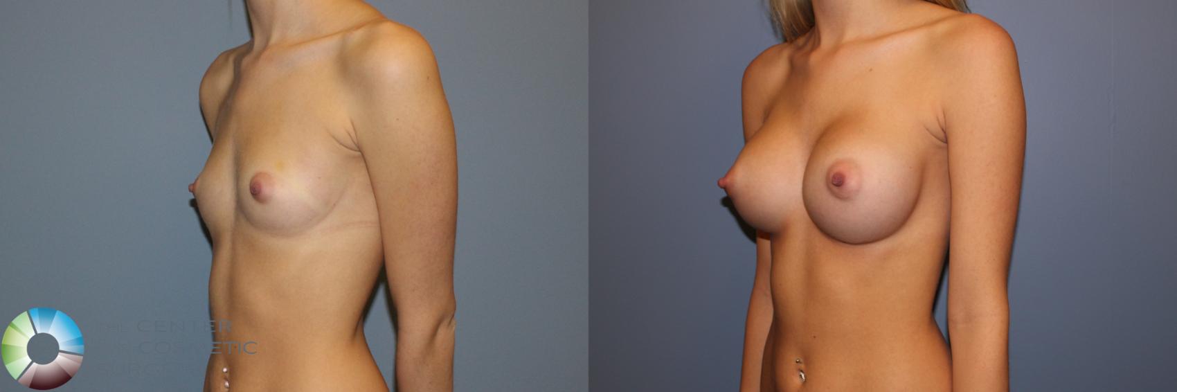 Before & After Breast Augmentation Case 11528 Left Oblique View in Golden, CO