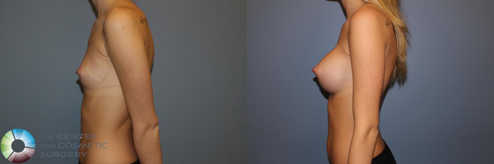 Before & After Breast Augmentation Case 11528 Left Side View in Golden, CO