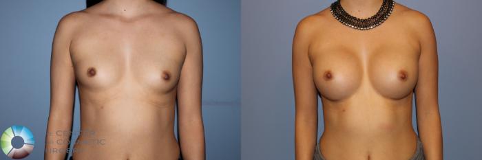 Before & After Breast Augmentation Case 11530 Front View in Golden, CO