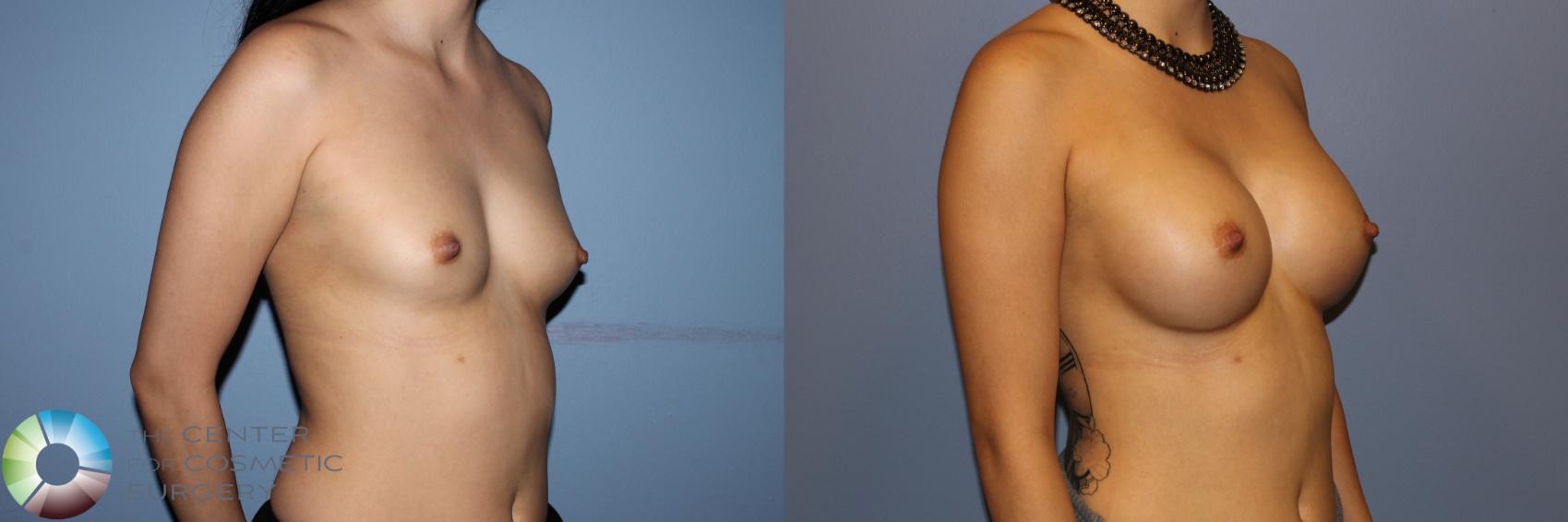 Before & After Breast Augmentation Case 11530 Left Oblique View in Golden, CO