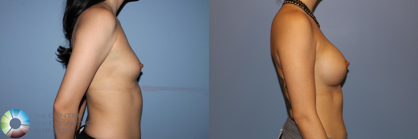 Before & After Breast Augmentation Case 11530 Left Side View in Golden, CO