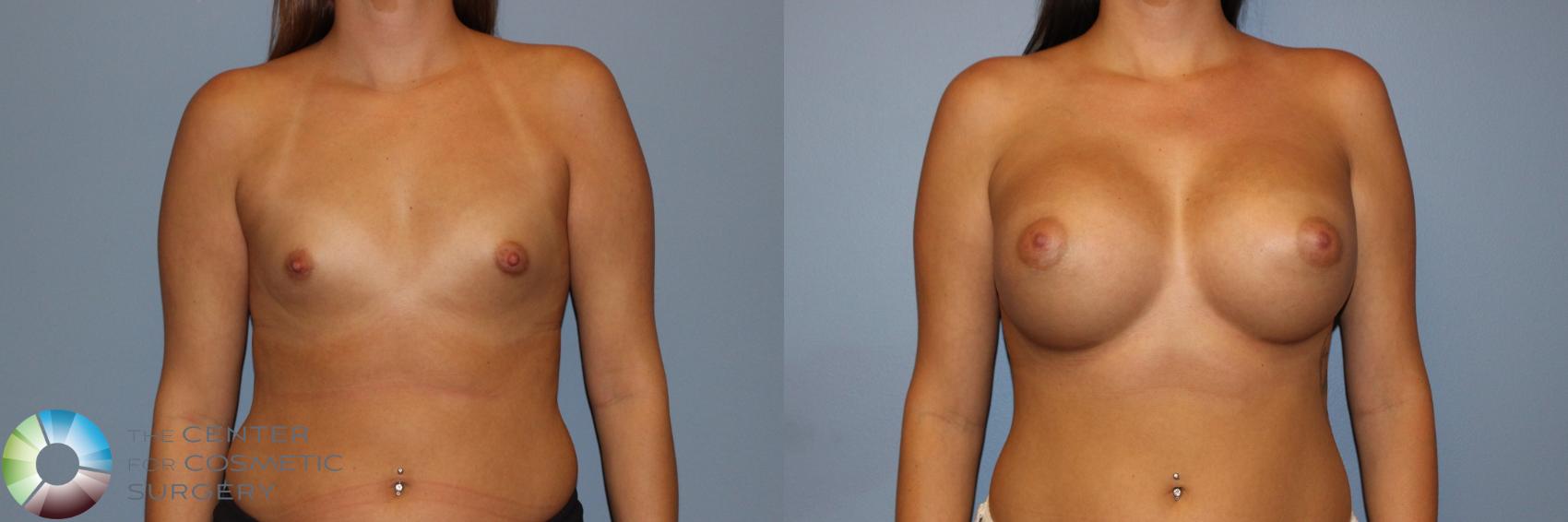 Before & After Breast Augmentation Case 11531 Front in Denver and Colorado Springs, CO