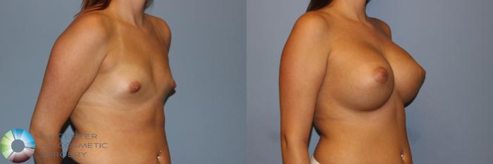 Before & After Breast Augmentation Case 11531 Left Oblique View in Golden, CO