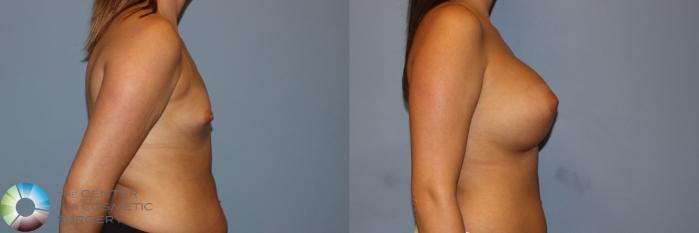 Before & After Breast Augmentation Case 11531 Left Side View in Golden, CO