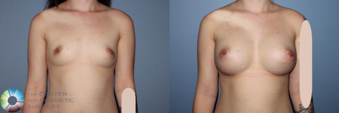 Before & After Breast Augmentation Case 11532 Front View in Golden, CO