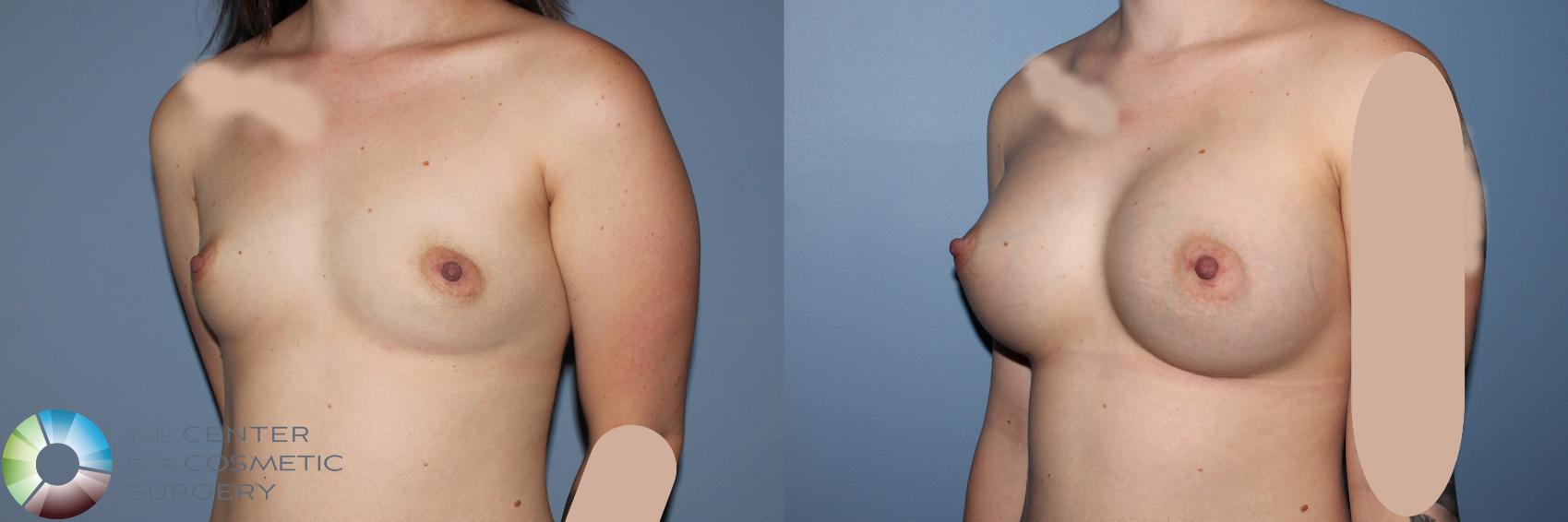Before & After Breast Augmentation Case 11532 Left Oblique in Denver and Colorado Springs, CO