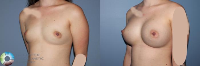 Before & After Breast Augmentation Case 11532 Left Oblique View in Golden, CO