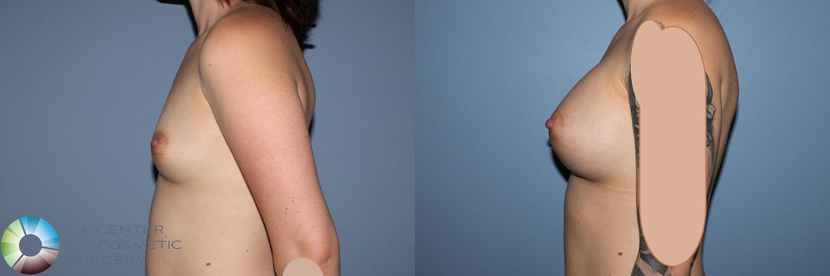Before & After Breast Augmentation Case 11532 Left Side in Denver and Colorado Springs, CO
