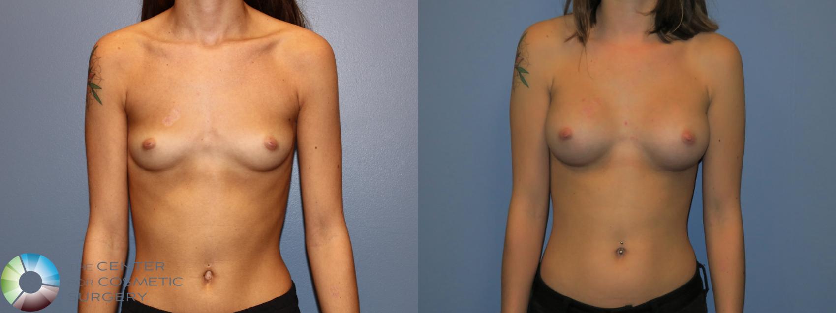 Before & After Breast Augmentation Case 11534 Front View in Golden, CO
