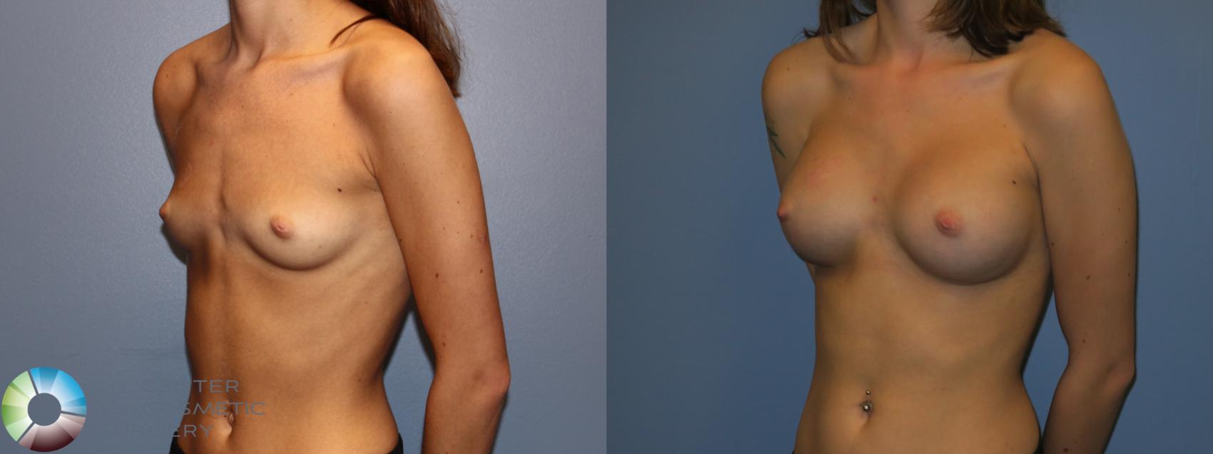 Before & After Breast Augmentation Case 11534 Right Oblique View in Golden, CO