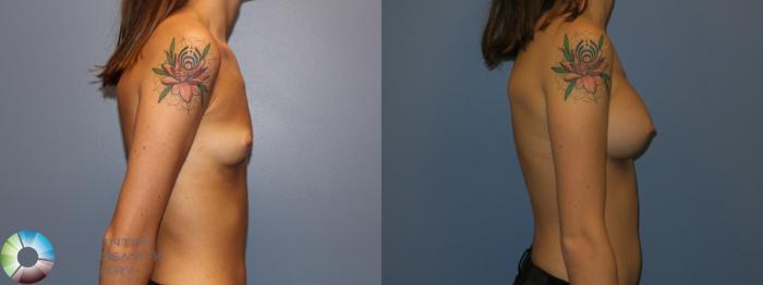 Before & After Breast Augmentation Case 11534 Right Side View in Golden, CO