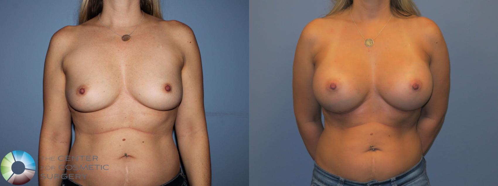Before & After Breast Augmentation Case 11535 Front View in Golden, CO