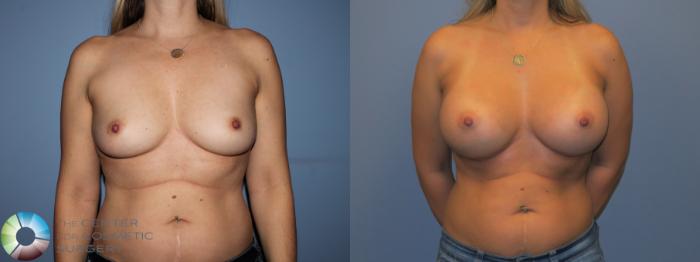 Before & After Breast Augmentation Case 11535 Front in Denver, CO