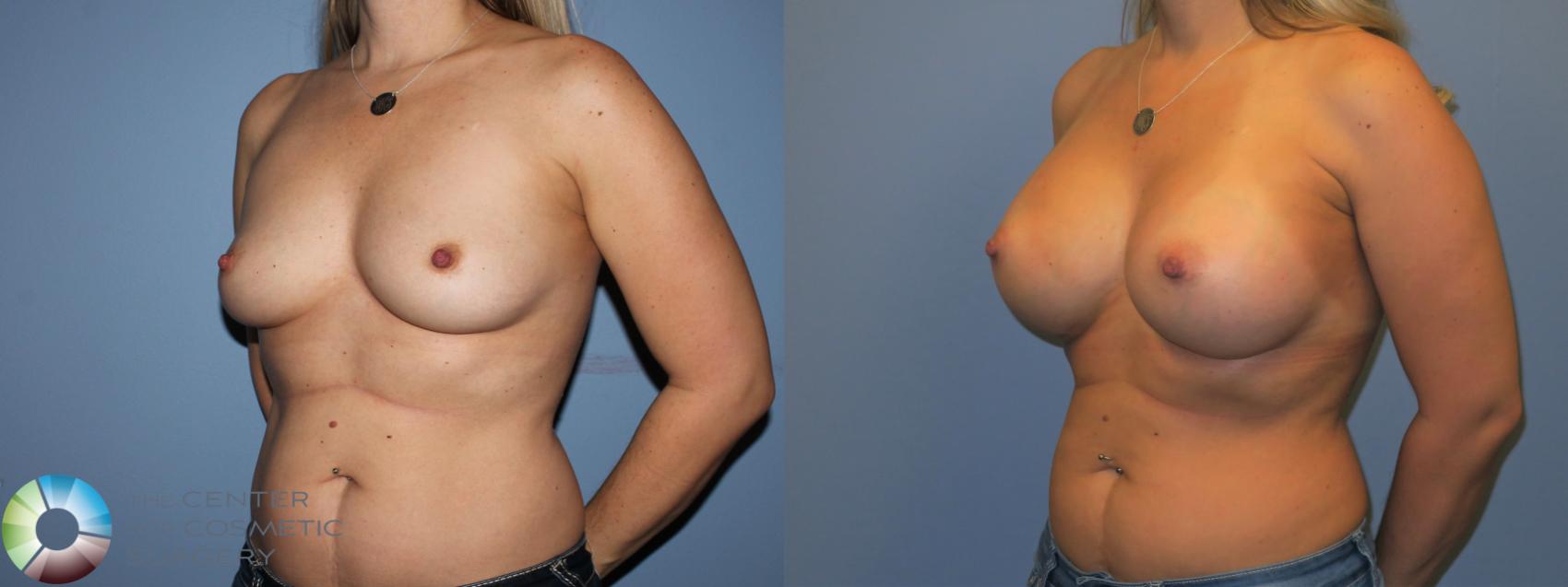 Before & After Breast Augmentation Case 11535 Left Oblique View in Golden, CO