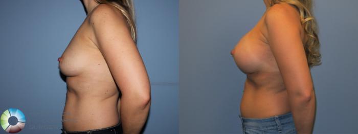 Before & After Breast Augmentation Case 11535 Left Side in Denver, CO