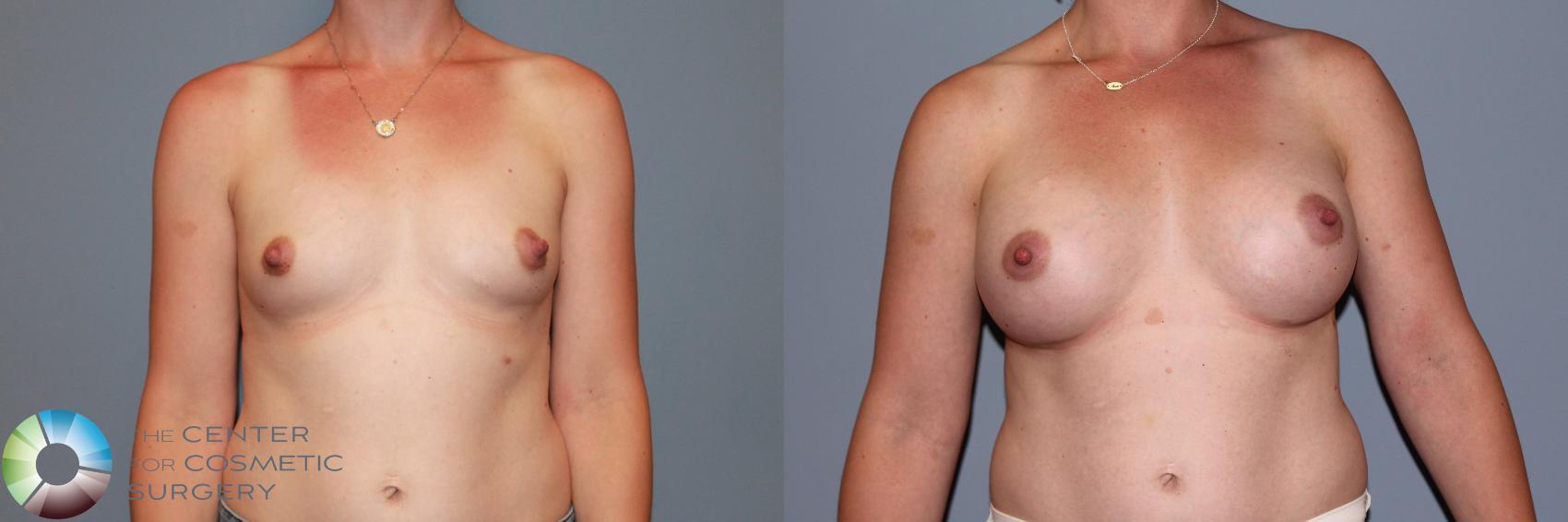 Before & After Breast Augmentation Case 11549 Front View in Golden, CO