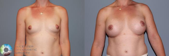 Before & After Breast Augmentation Case 11549 Front in Denver and Colorado Springs, CO