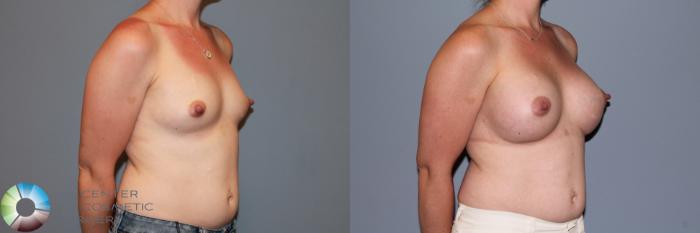 Before & After Breast Augmentation Case 11549 Right Oblique in Denver and Colorado Springs, CO