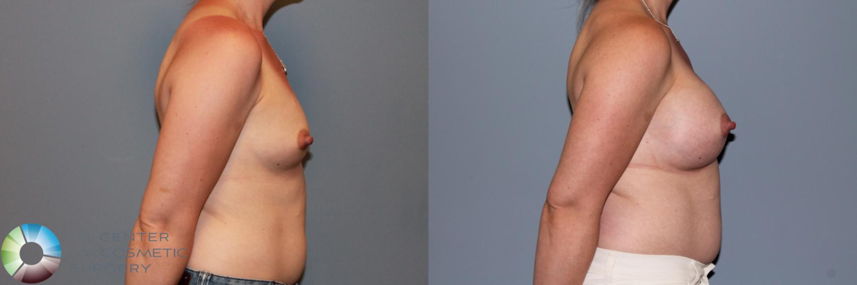 Before & After Breast Augmentation Case 11549 Right Side View in Golden, CO