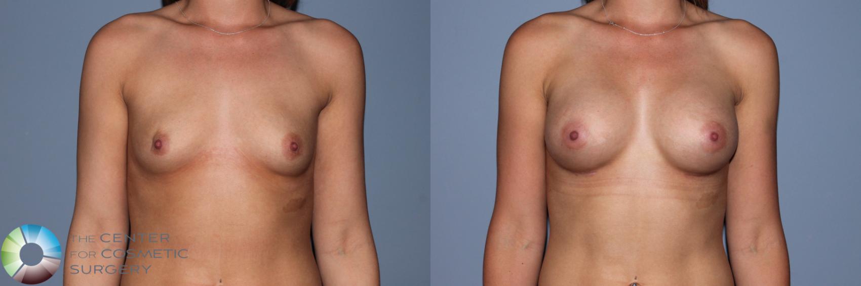 Before & After Breast Augmentation Case 11550 Front View in Golden, CO