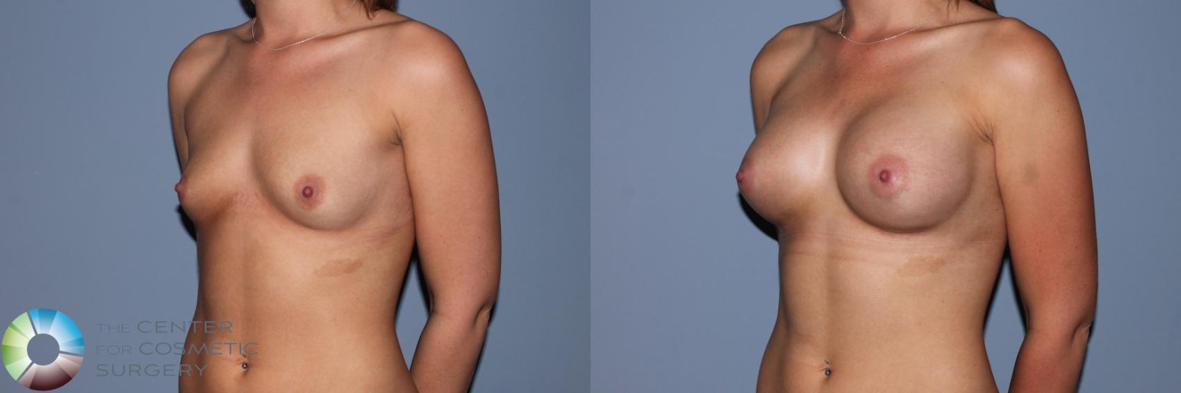 Before & After Breast Augmentation Case 11550 Left Oblique in Denver and Colorado Springs, CO