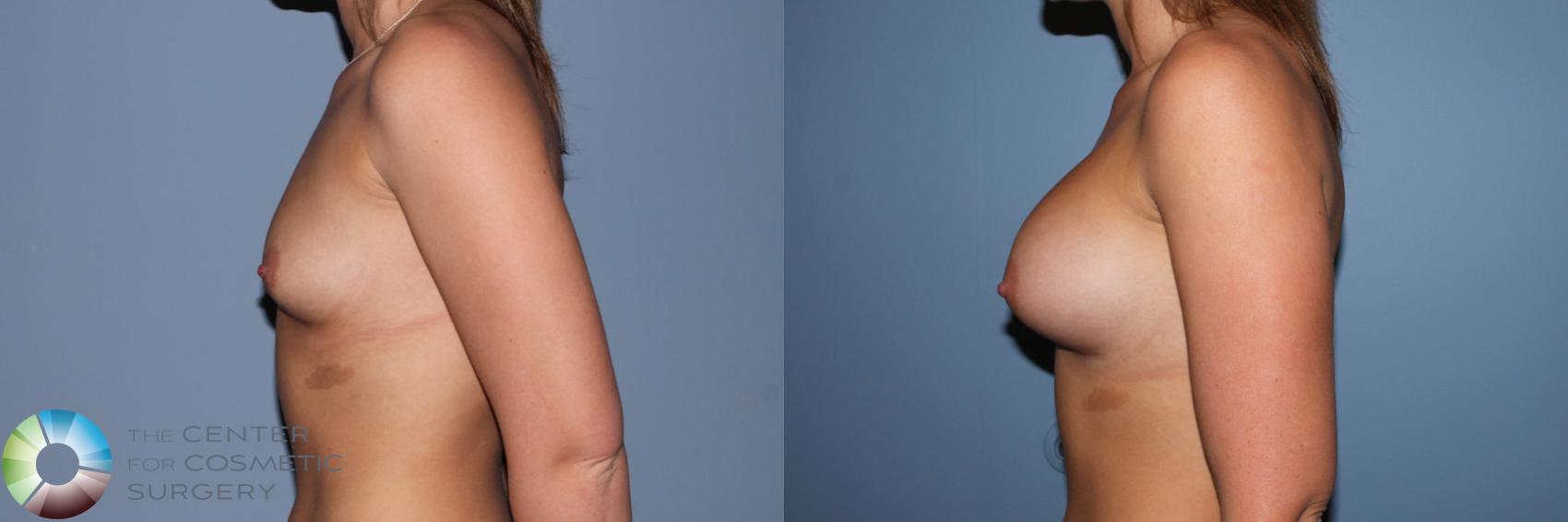 Before & After Breast Augmentation Case 11550 Left Side in Denver and Colorado Springs, CO