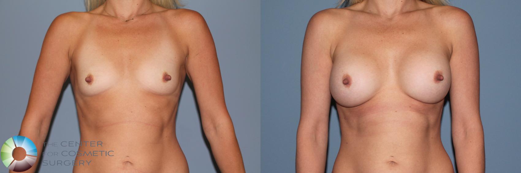 Before & After Breast Augmentation Case 11551 Front View in Golden, CO