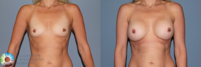 Before & After Breast Augmentation Case 11551 Front in Denver and Colorado Springs, CO