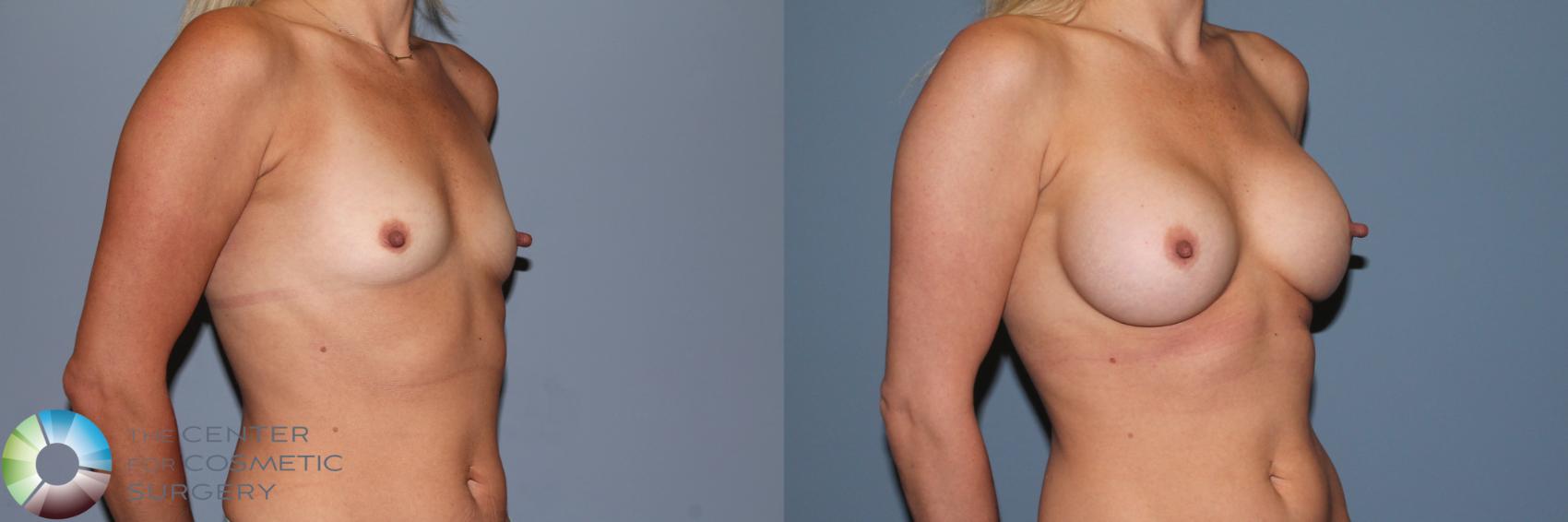 Before & After Breast Augmentation Case 11551 Right Oblique View in Golden, CO