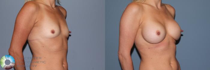 Before & After Breast Augmentation Case 11551 Right Oblique in Denver and Colorado Springs, CO