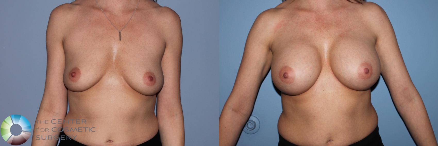 Before & After Breast Augmentation Case 11552 Front View in Golden, CO