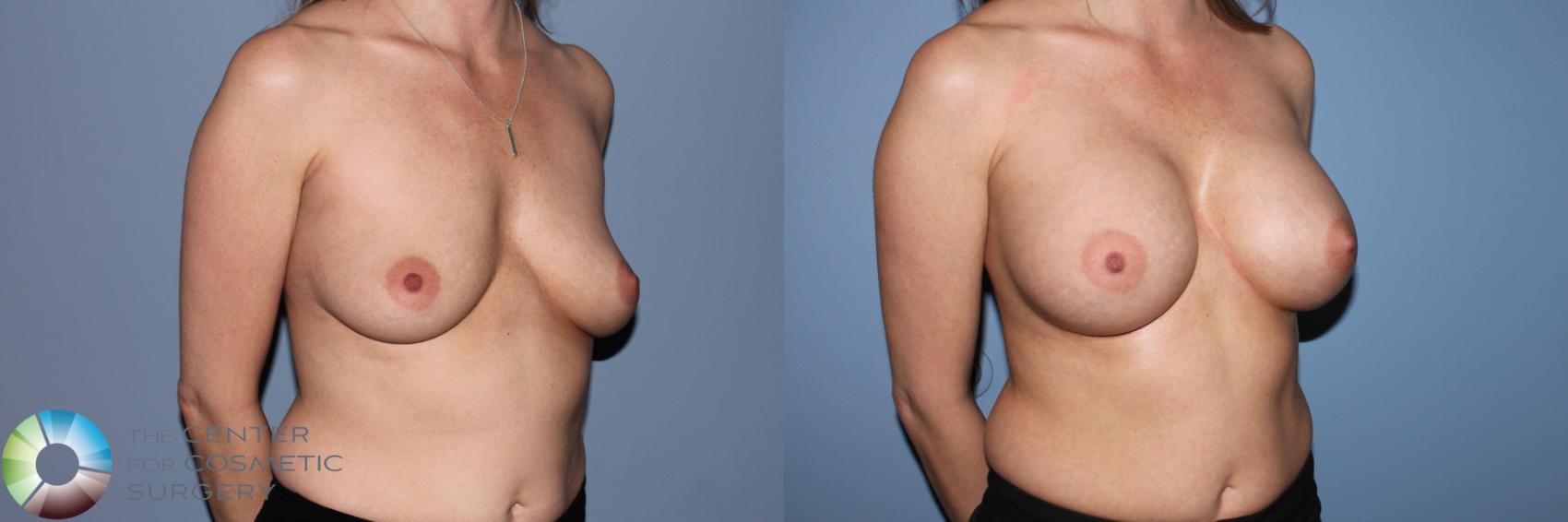 Before & After Breast Augmentation Case 11552 Right Oblique View in Golden, CO