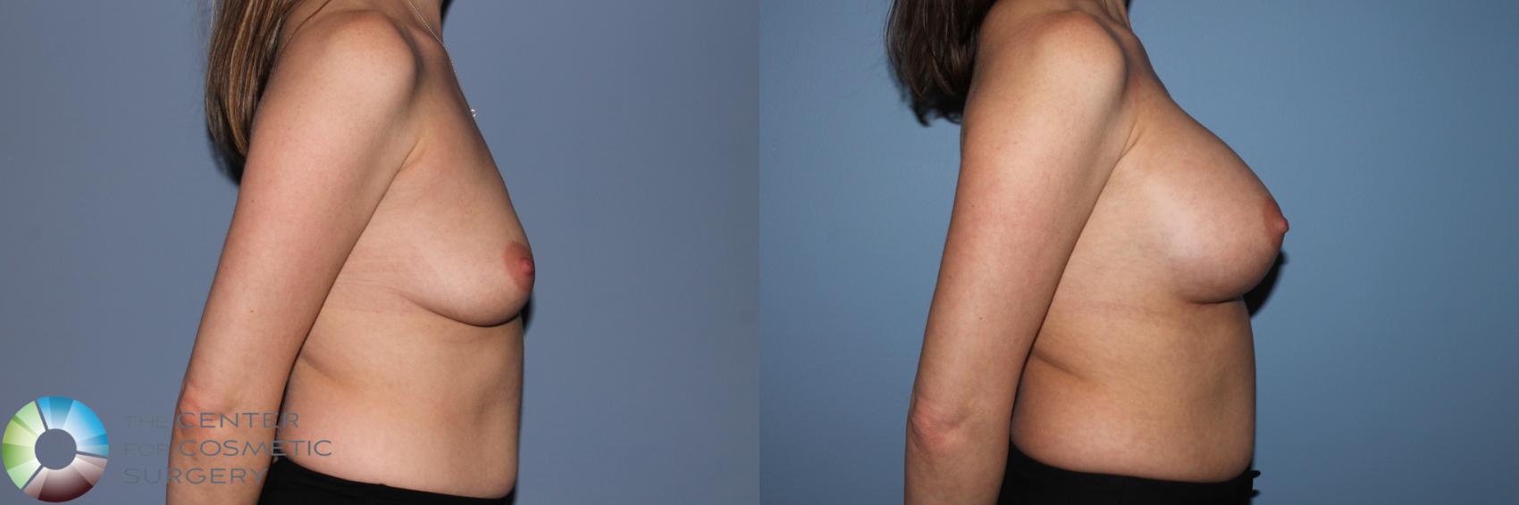 Before & After Breast Augmentation Case 11552 Right Side View in Golden, CO