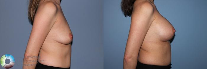 Before & After Breast Augmentation Case 11552 Right Side in Denver and Colorado Springs, CO