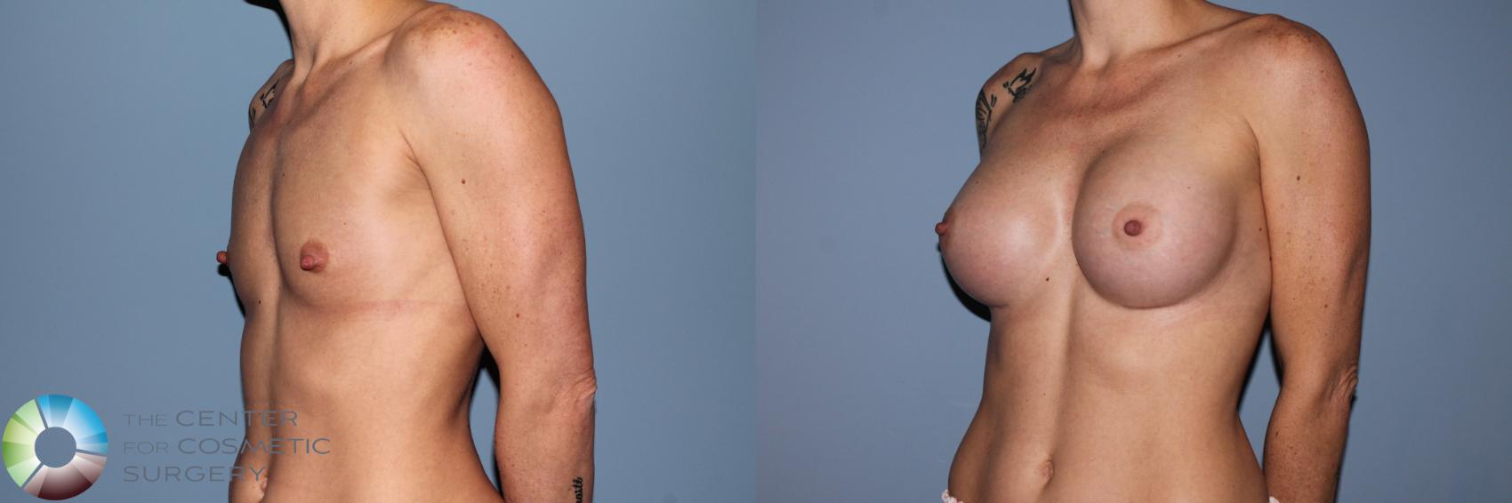 Before & After Breast Augmentation Case 11555 Left Oblique in Denver and Colorado Springs, CO
