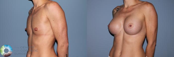 Before & After Breast Augmentation Case 11555 Left Oblique View in Golden, CO
