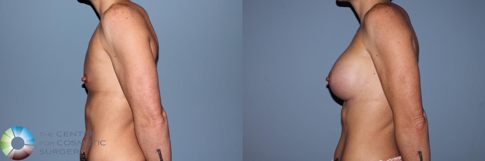 Before & After Breast Augmentation Case 11555 Left Side in Denver and Colorado Springs, CO