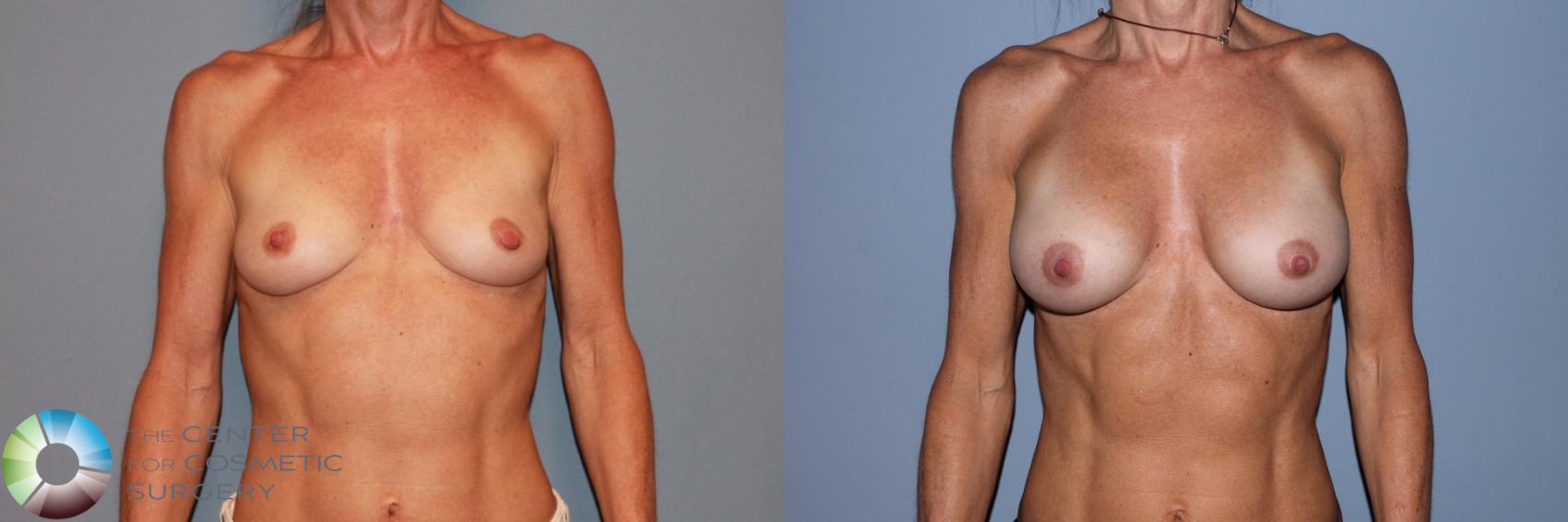 Before & After Breast Augmentation Case 11556 Front View in Golden, CO