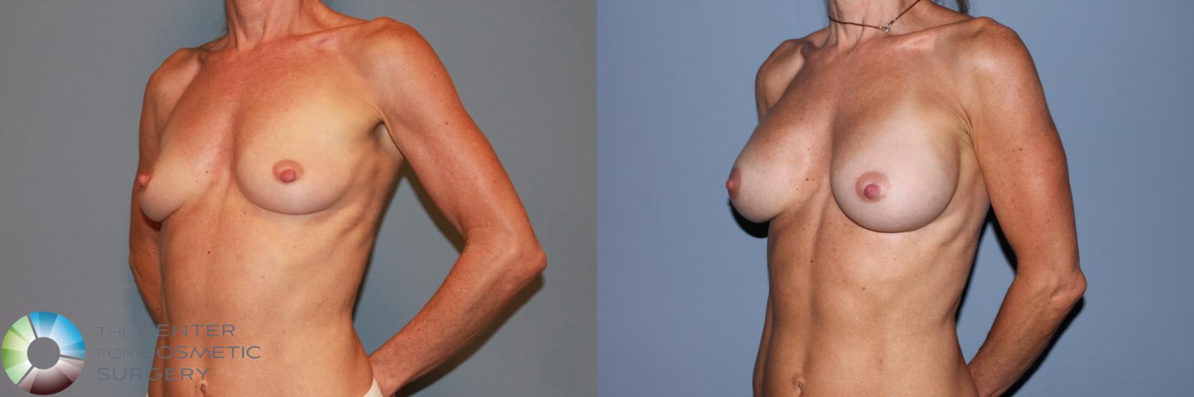 Before & After Breast Augmentation Case 11556 Left Oblique View in Golden, CO
