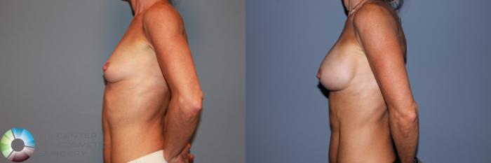 Before & After Breast Augmentation Case 11556 Left Side View in Golden, CO