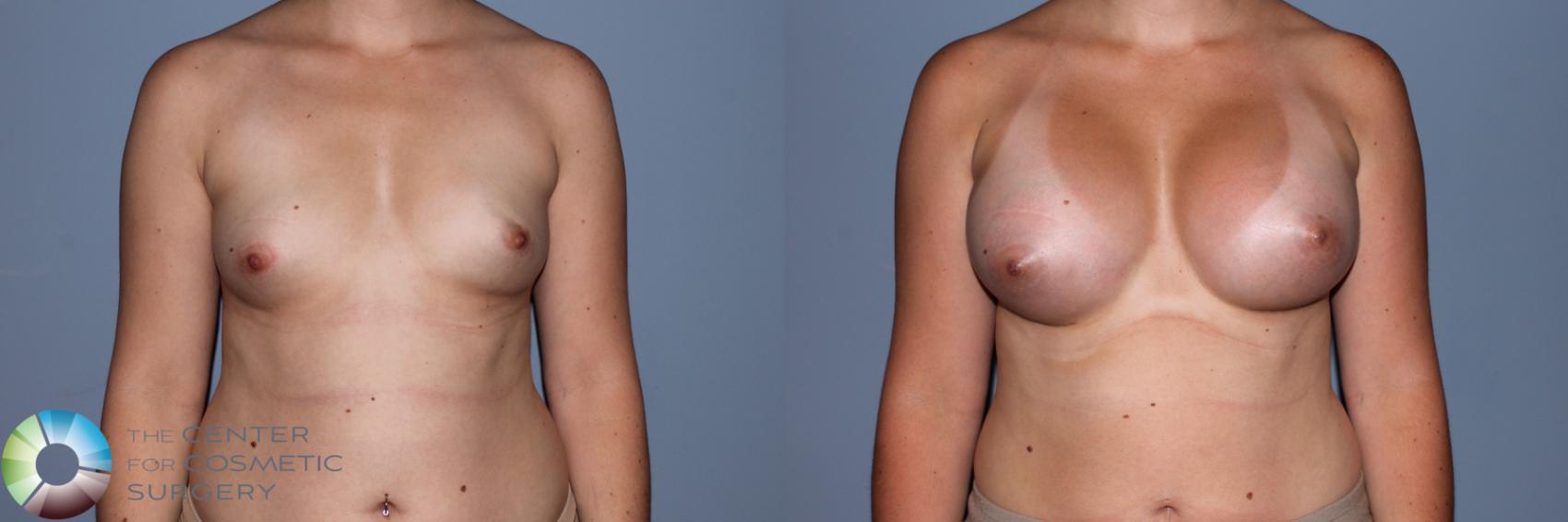 Before & After Breast Augmentation Case 11557 Front View in Golden, CO