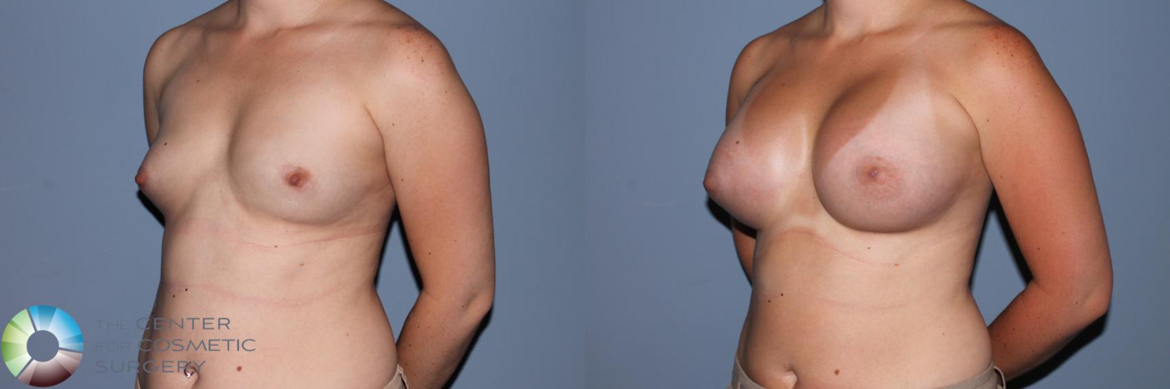 Before & After Breast Augmentation Case 11557 Left Oblique in Denver and Colorado Springs, CO