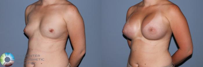 Before & After Breast Augmentation Case 11557 Left Oblique View in Golden, CO