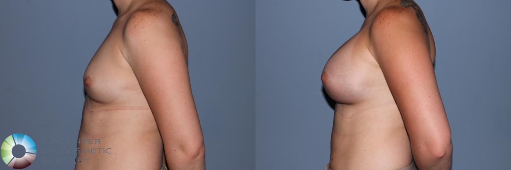 Before & After Breast Augmentation Case 11557 Left Side in Denver and Colorado Springs, CO
